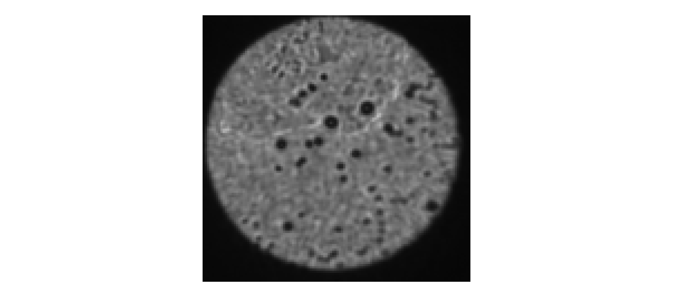 Figure 4.2. Dirty distal facet.